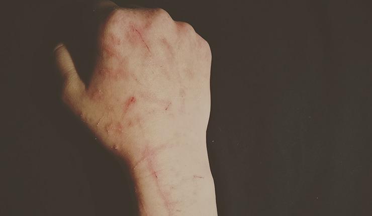 Self Injury: When Pain Feels Good